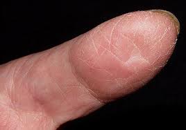 Los baños de miel a la psoriasis